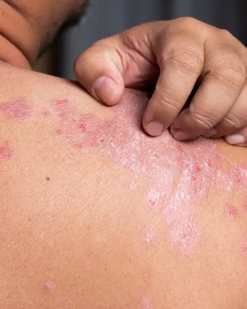 Estratégia Nutricional Na Psoriase